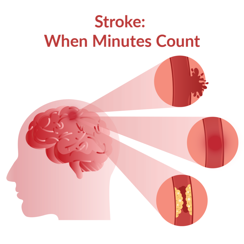 First Aid For Strokes