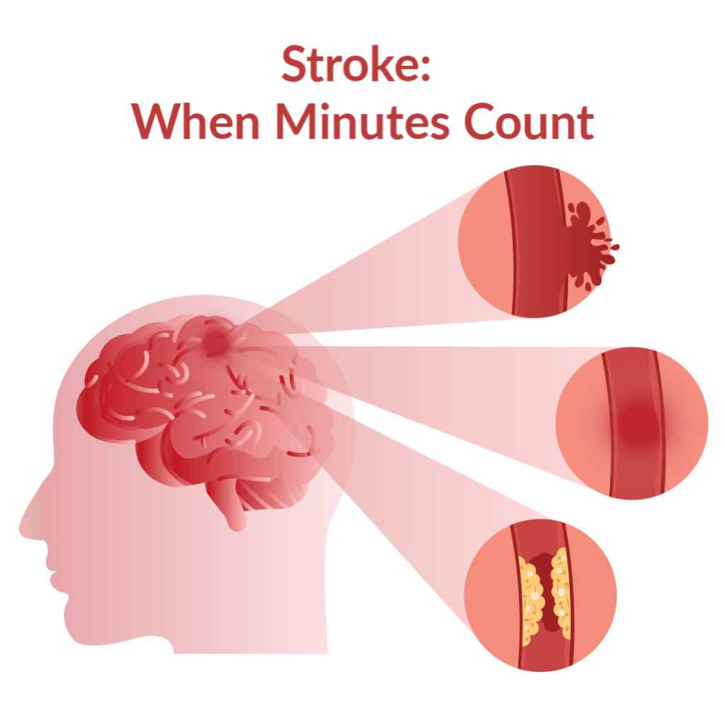 Hypertension during the Acute Phase of Stroke