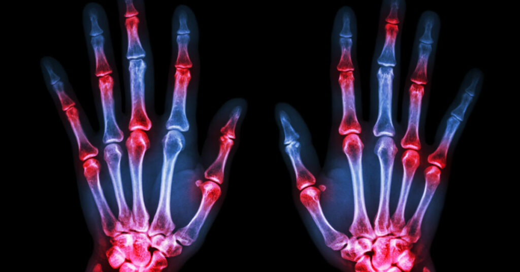 Arthritis Signs and Symptoms