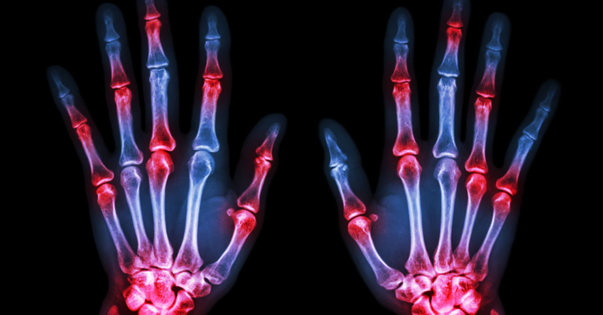Lift heavy for bone health - Rheuma
