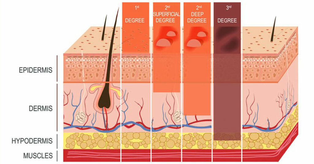 what causes second degree burns