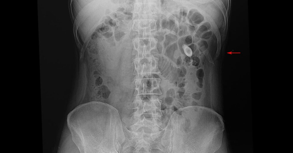 struvite kidney stones xray