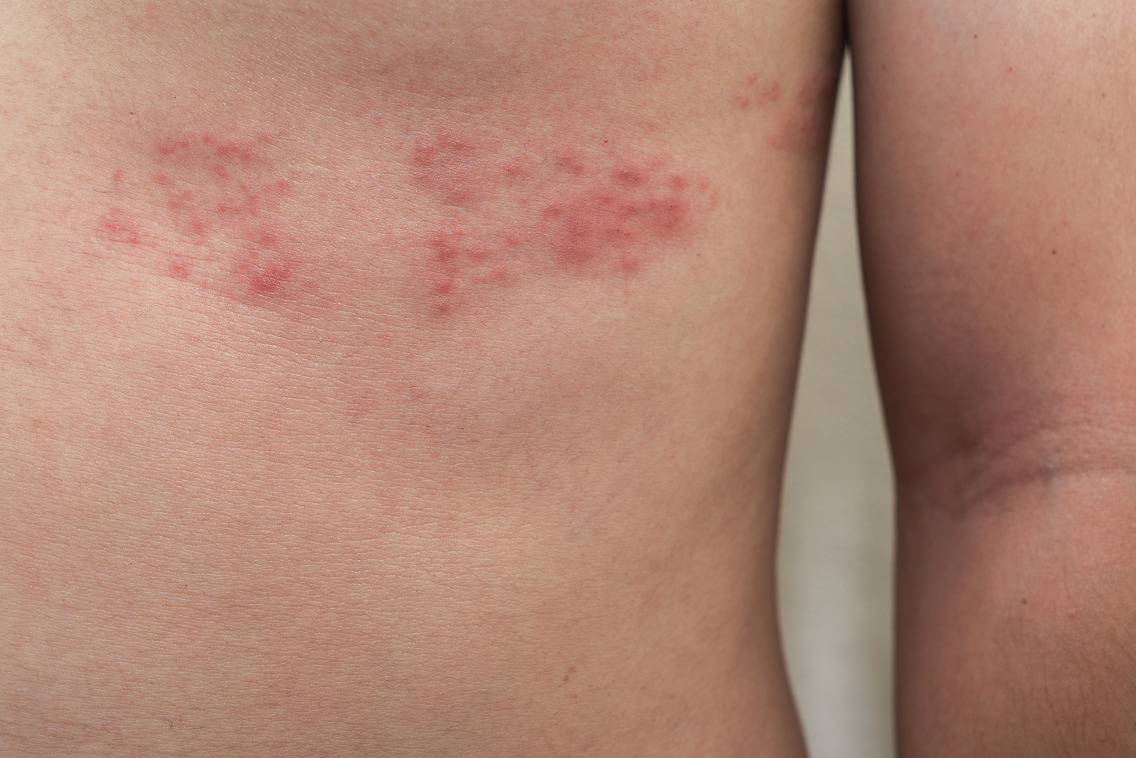 Shingles Rash 