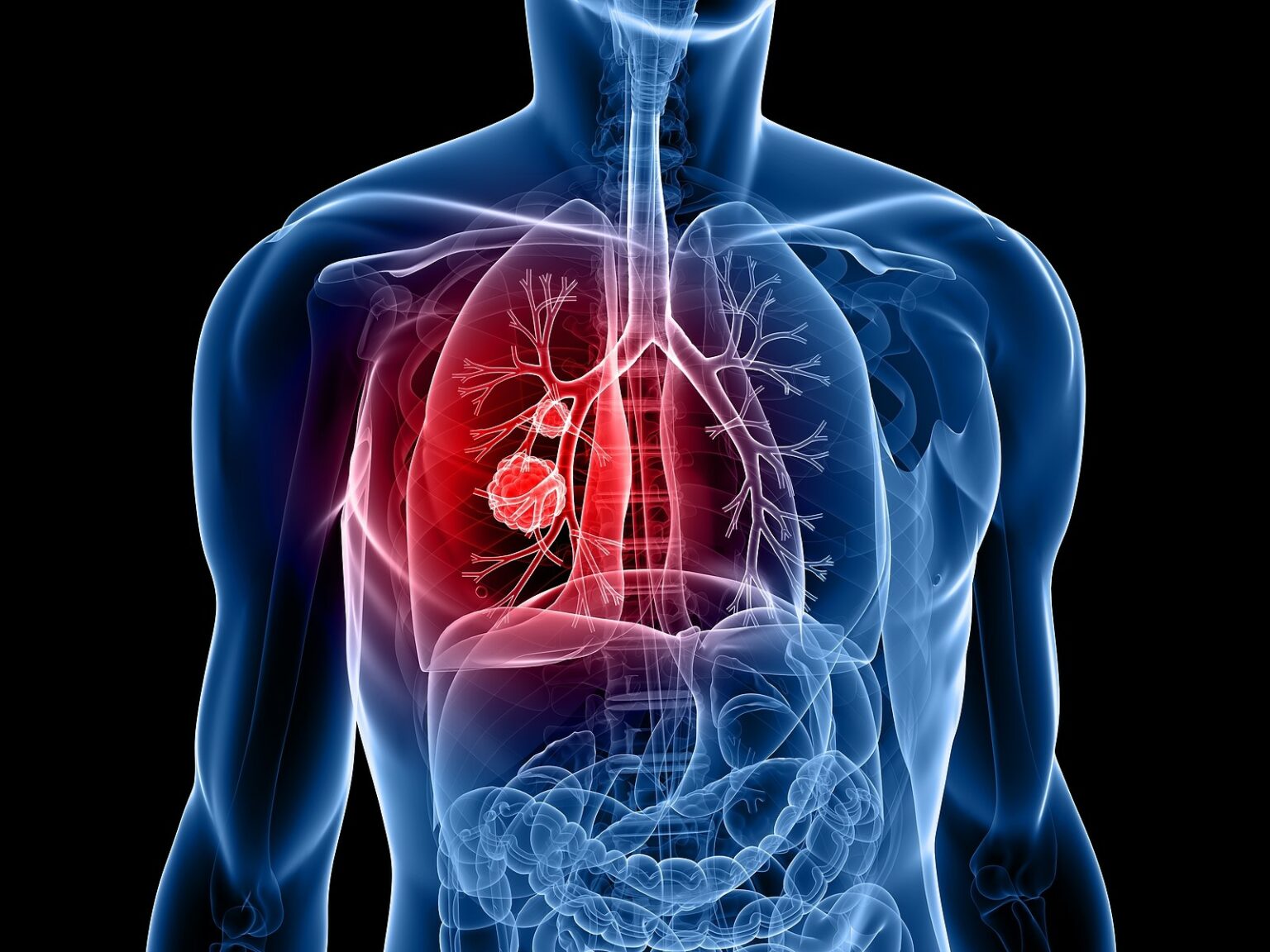 How Do You Know You Have Lung Cancer