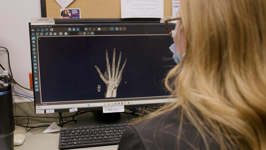 Bone Fractures